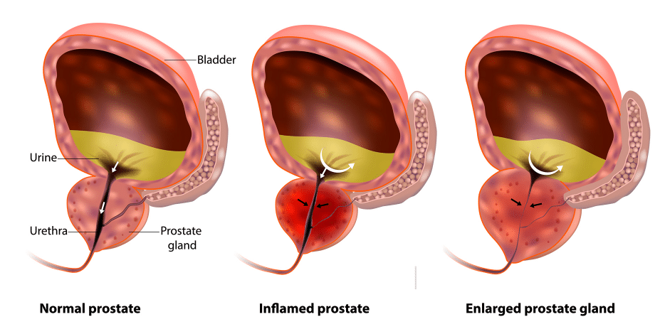 Prostate health